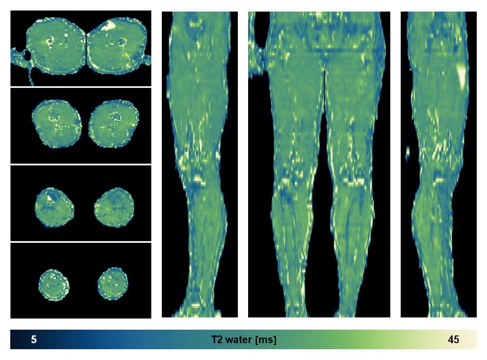 The water only T2 relaxation time of the lower extremity obtained from multi echo spin echo t2 mapping with EPG based reconstruction.